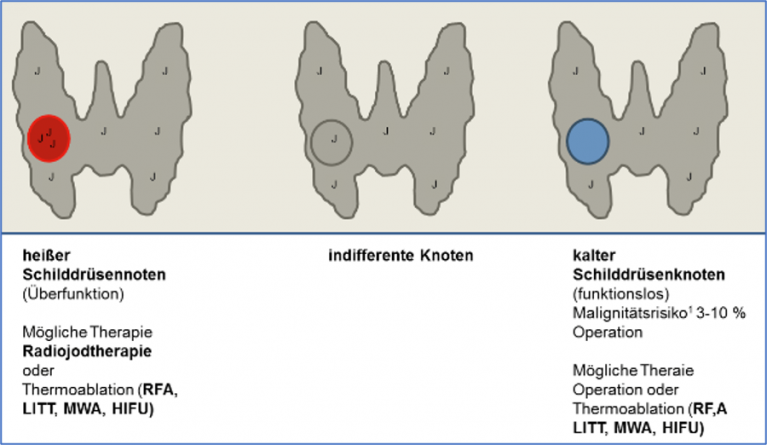 Was Ist Ein Kalter Knoten In Der Schilddrüse dzta.de