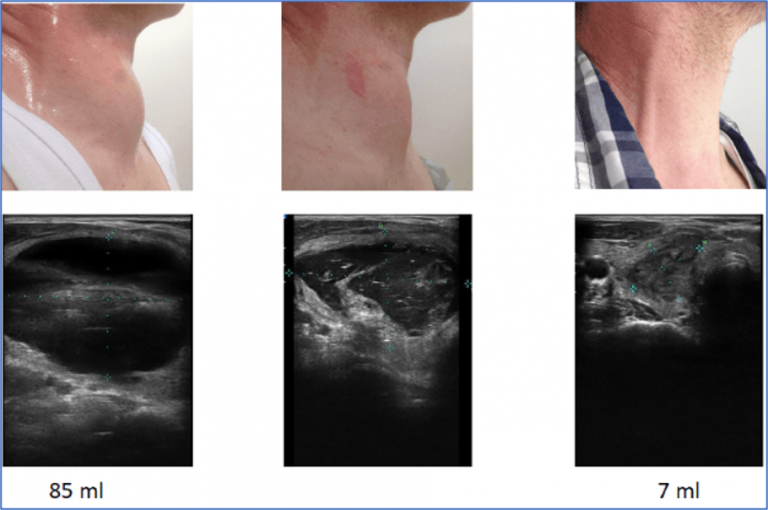 Erfahrungsberichte Deutsches Zentrum für Thermoablation e.V.