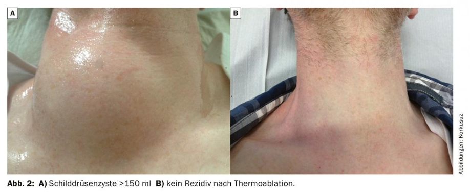 Erfahrungsberichte - Deutsches Zentrum für Thermoablation e.V.